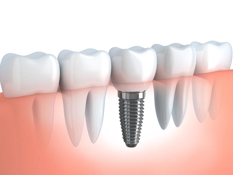 Dental Implants  Thurmont, MD 